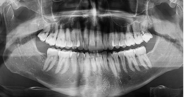 A digital black and white panoramic 3D dental X-ray showing the complete upper and lower jaw, teeth roots, and sinus cavities.