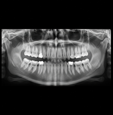 A detailed digital black and white panoramic 3D dental X-ray showing the complete upper and lower jaw, teeth roots, and jawbone structure.