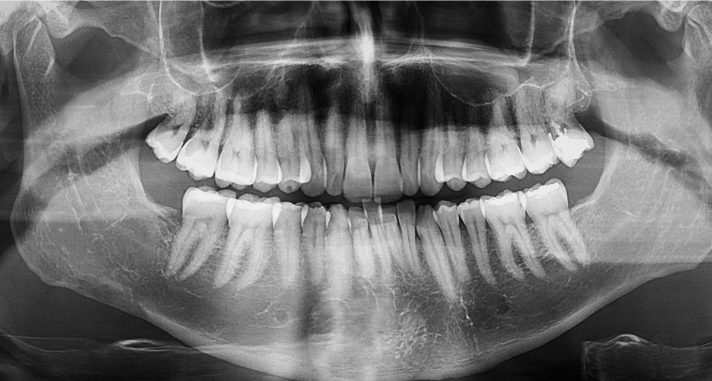 A high-definition digital panoramic dental X-ray showing the complete upper and lower jaw, teeth roots, and jawbone structure in a wide-angle view.