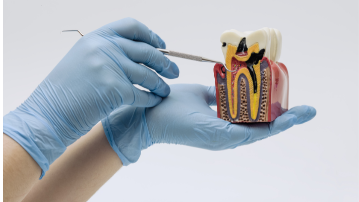 A detailed anatomical model of a tooth showing deep decay reaching the pulp, held by a dental professional in blue gloves.