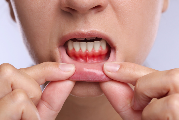 Close-up of a patient showing red, inflamed, and swollen gums, which are primary symptoms of early periodontal disease.