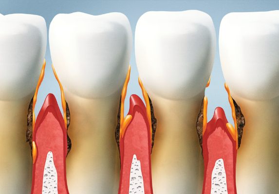 A detailed dental model showing a cross-section of a tooth with decay reaching the pulp, illustrating why early periodontal intervention is vital.