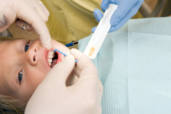 A dental professional applying a professional-grade fluoride varnish to a young child's teeth using a precision applicator tool.