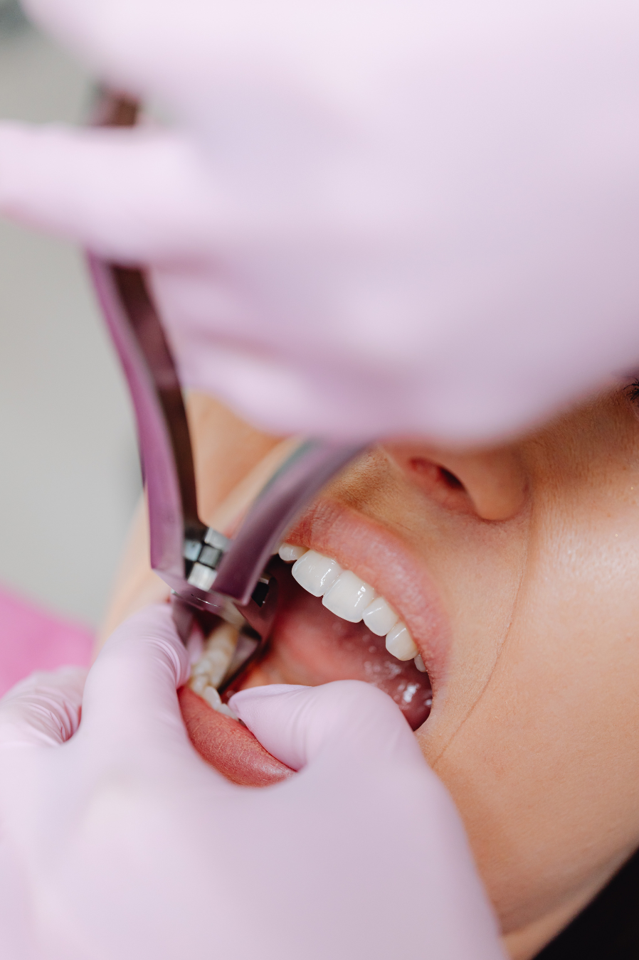 A dental professional in pink gloves using specialized dental forceps to perform a simple tooth extraction on a patient.