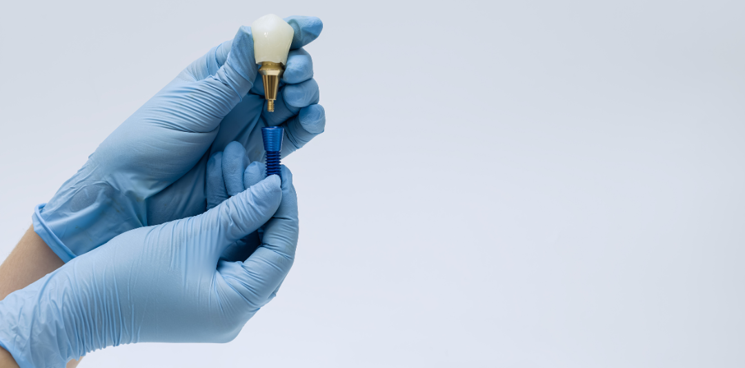 A dental professional fitting a multi-unit bridge onto implant posts on a laboratory model.