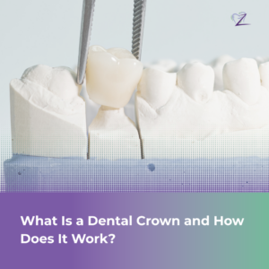 Close-up of a modern, realistic dental crown model being placed on a tooth structure against a clean background.
