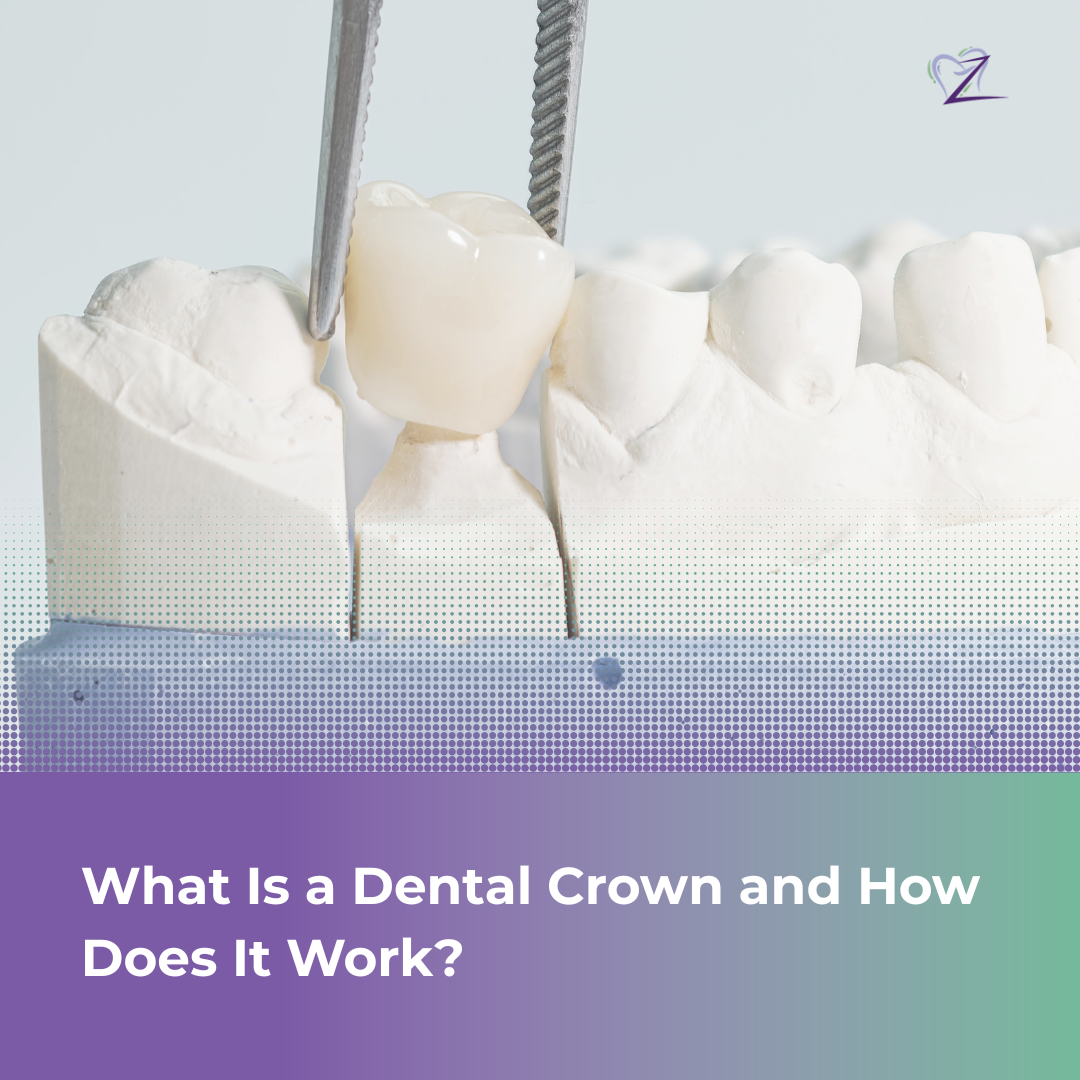 Close-up of a modern, realistic dental crown model being placed on a tooth structure against a clean background.